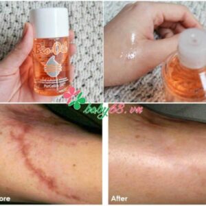 Tinh Dau Tri Ran Da Tri Seo Bio Oil3